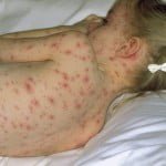 Chicken-pox in France