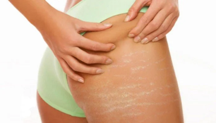 Stretch Marks