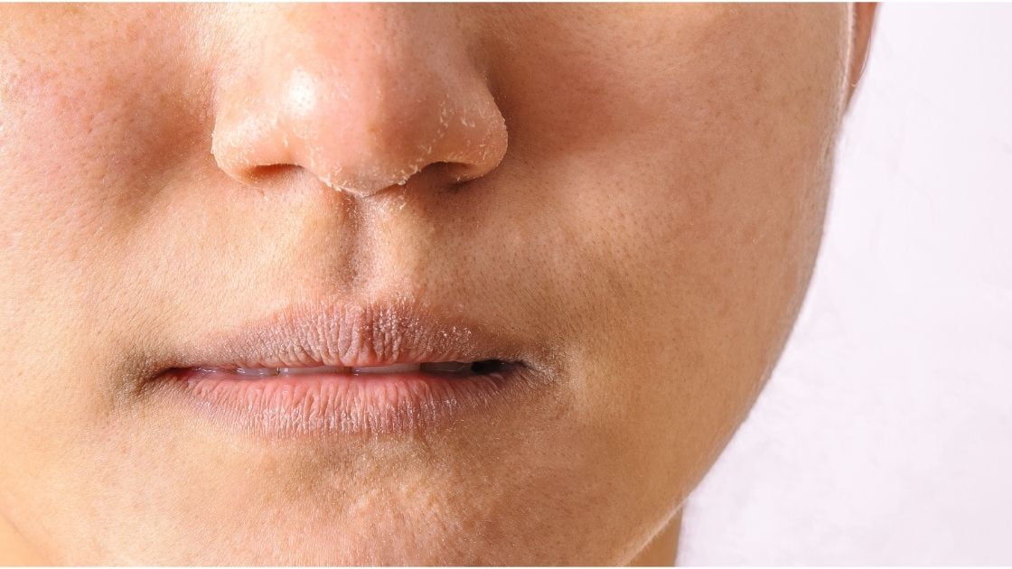 Dry Skin Around the Nose Experts Say How You Can Get Rid of It I AM & CO