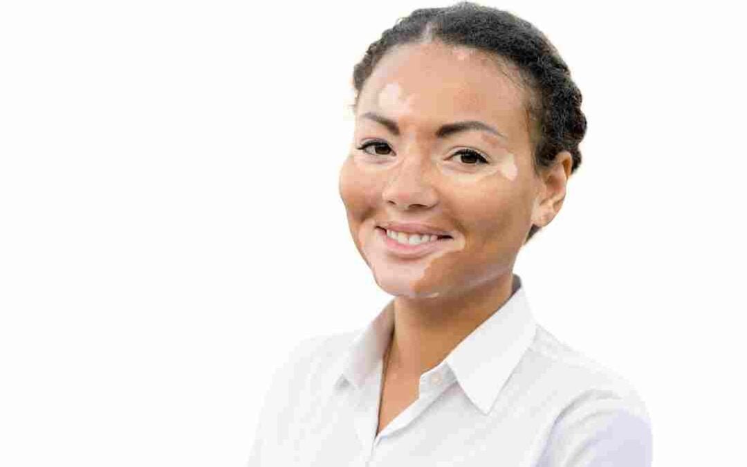 Best Home Remedy for White Patches on Skin
