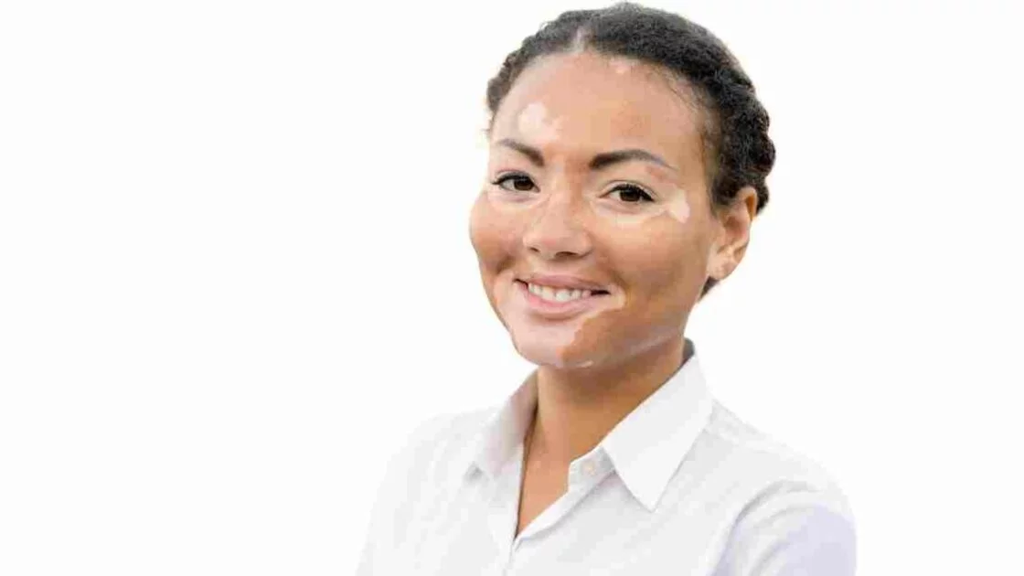 Best Home Remedy for White Patches on Skin