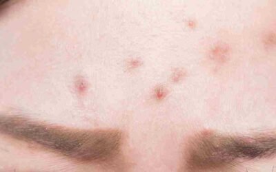 Forehead acne: Causes, tips and home remedies