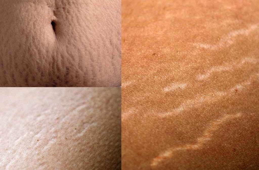 How to Get Rid of Stretch Marks Fast