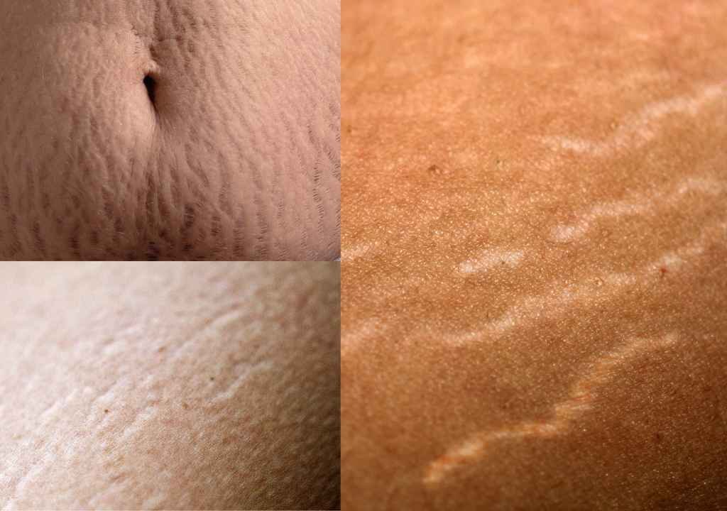 How to Get Rid of Stretch Marks Fast How to Get Rid of Stretch Marks Fast