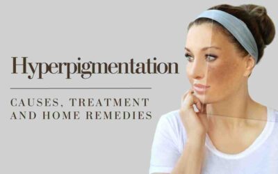 DIY Home Remedies To Reduce Hyperpigmentation