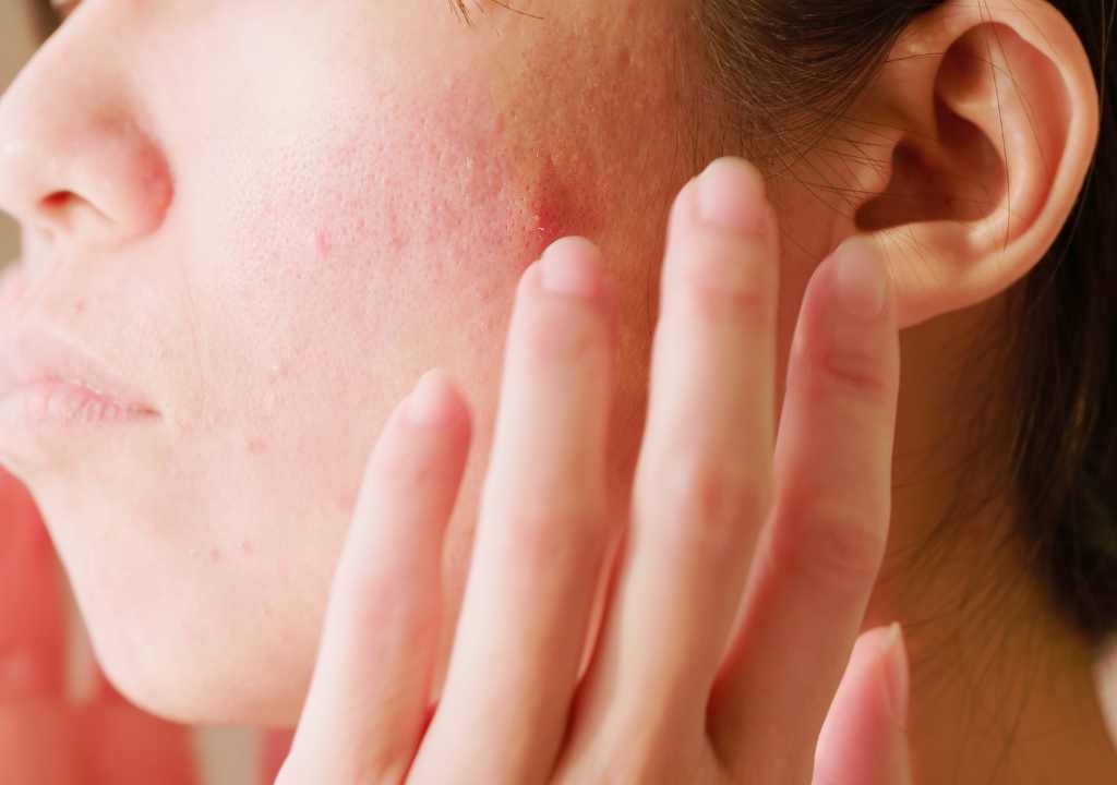 How to Soothe Sensitive Skin at home