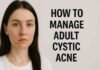 The Best Acne Treatment for Adult Cystic Acne: A Professional Guide to Highly Effective Therapies best acne treatment for adult cystic acne