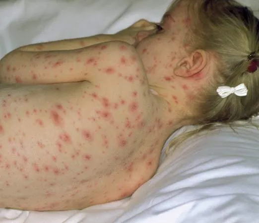 chickenpox epidemic in Midi- Pyrenees