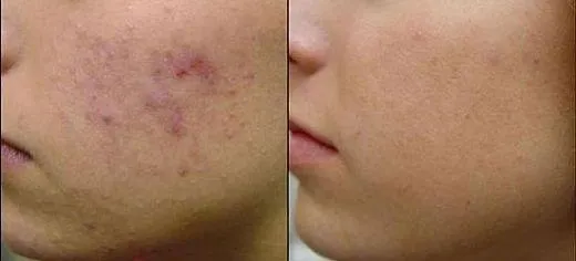 Acne Scar Removal Treatment