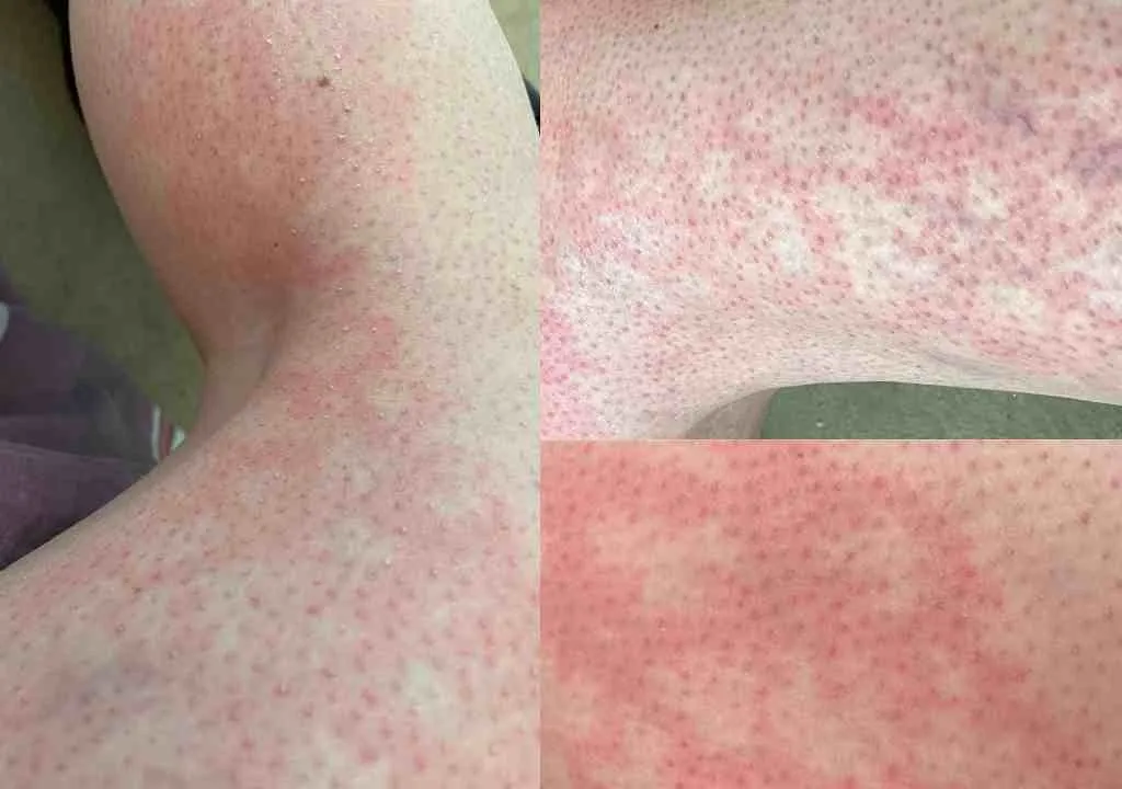 Toasted Skin Syndrome Treatment