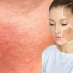 Signs of Damaged Skin Barrier