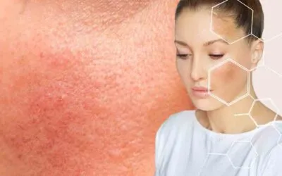 Understanding the Signs of Damaged Skin Barrier and How to Repair It