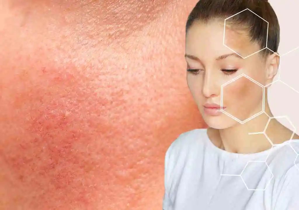 Signs of Damaged Skin Barrier