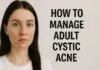 best acne treatment for adult cystic acne